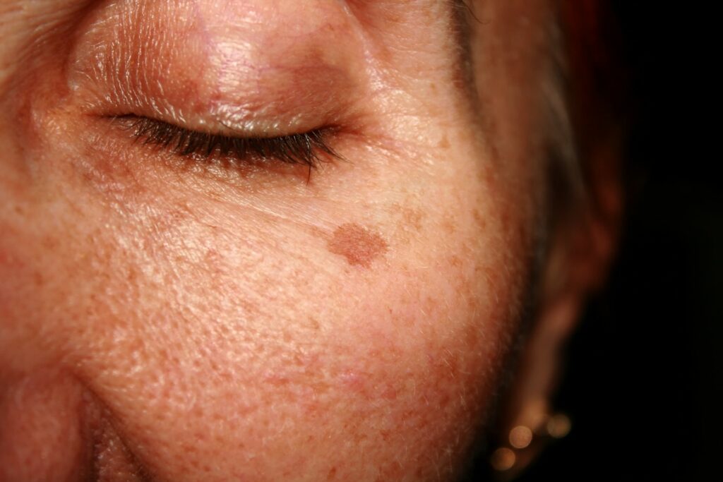 age spots photoaging woman face