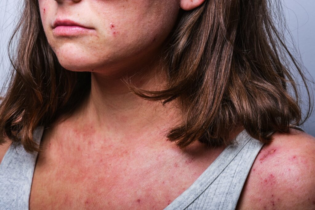 Young girl psoriasis acne eczema