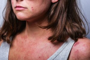 Young girl psoriasis acne eczema