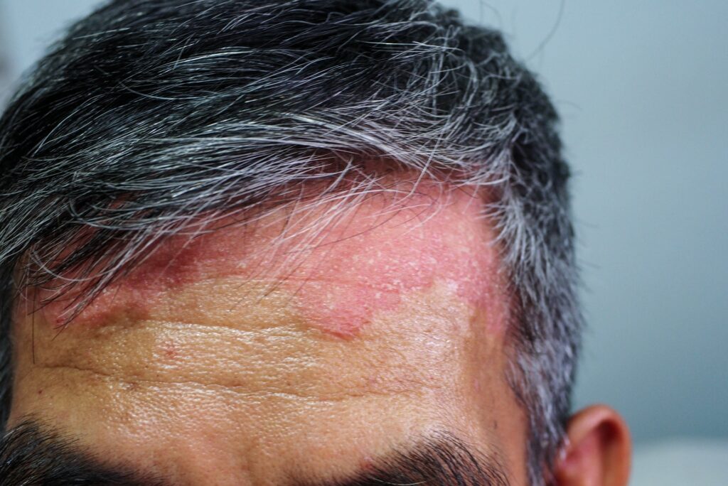 man psoriasis scalp