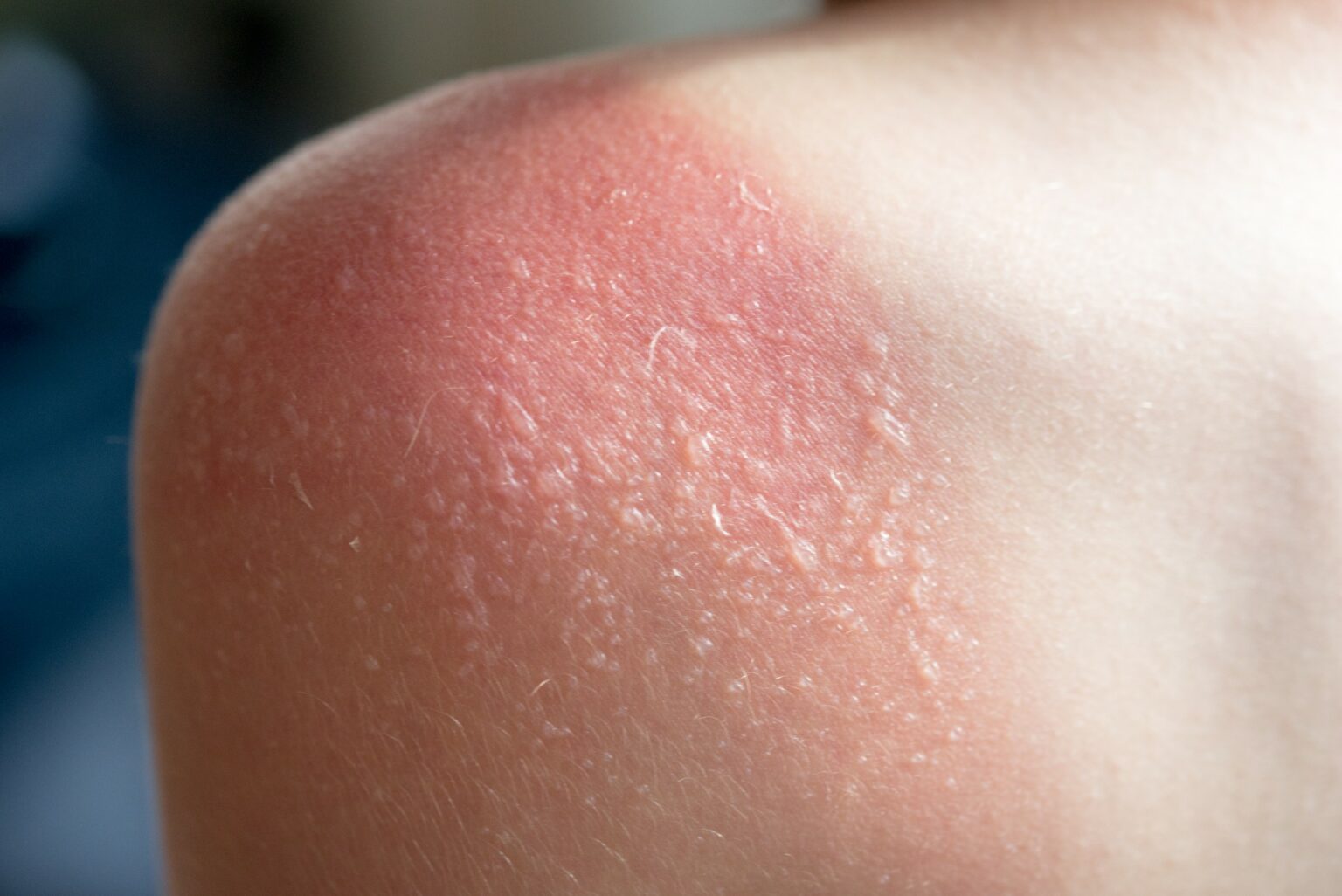 Dermatologist Advice On Treating Sunburns This Summer Buckhead