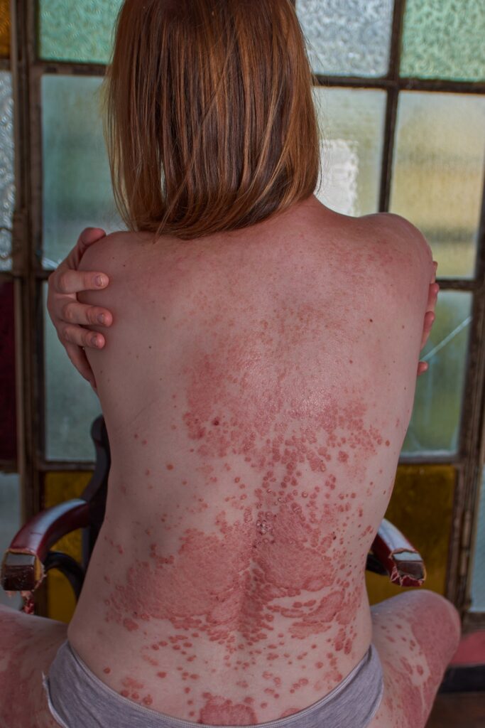 woman back psoriasis