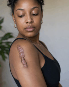 keloid treatment atlanta