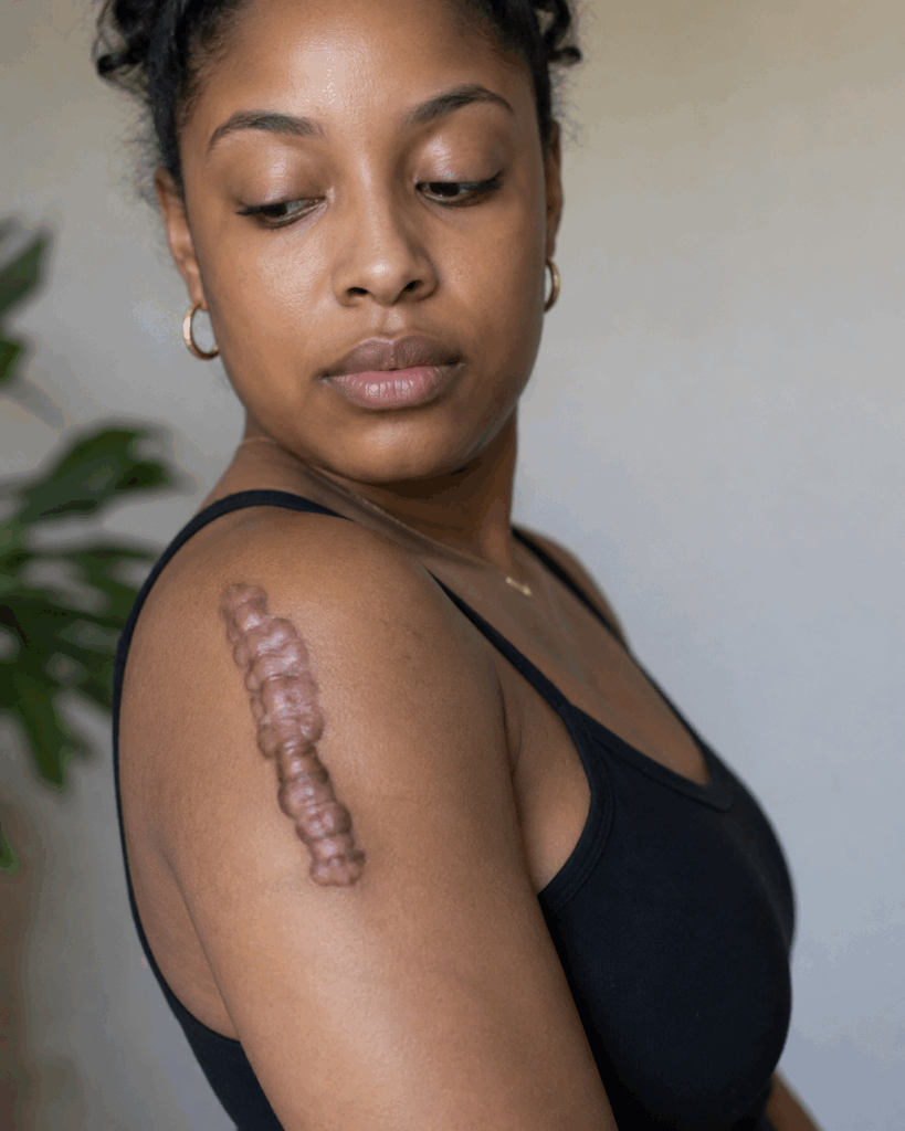 keloid treatment atlanta