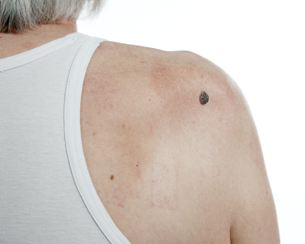 4 Types of Skin Cancer To Know About Buckhead Dermatology