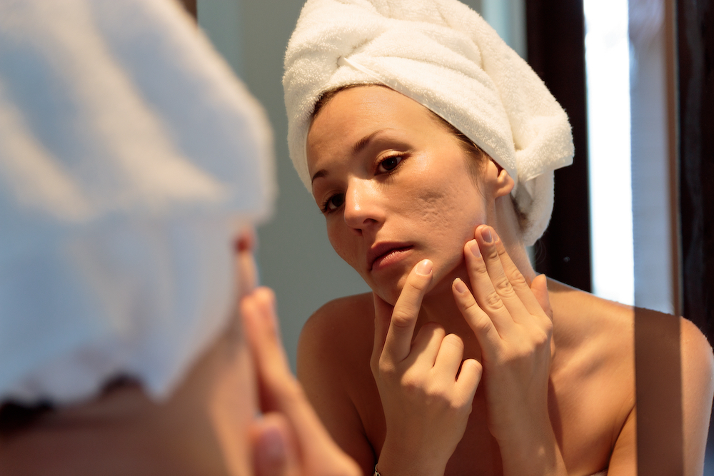 adult acne treatments near me