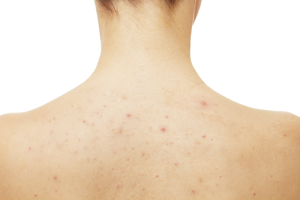 Cystic Back Acne Causes And How To Treat It 40 Off