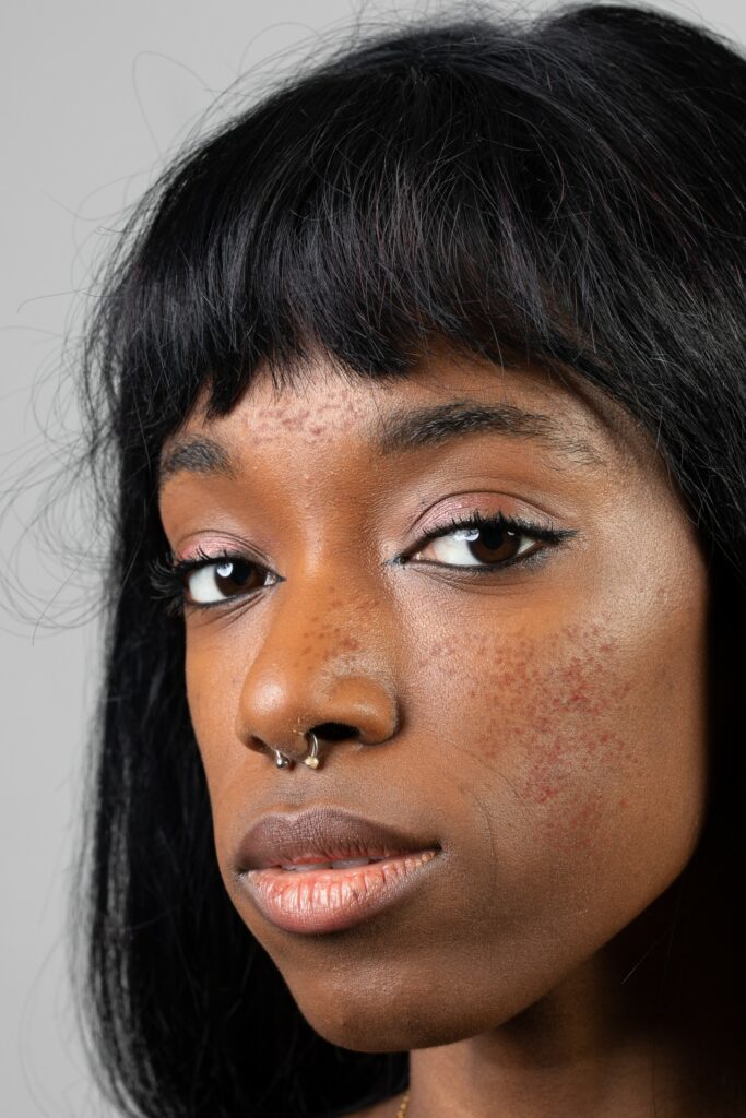 black skin acne rosacea dermatologist