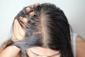 woman oily hair and skin