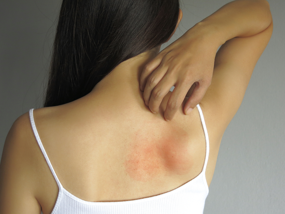 What Are Heat Hives? - The Dermatology Clinic