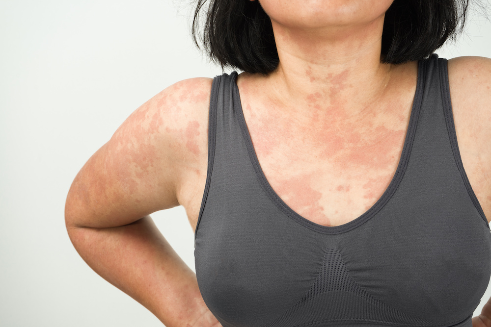 Hives 101: What You Need to Know - Buckhead Dermatology