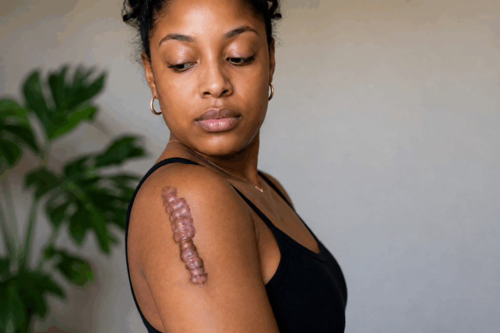 keloid treatment atlanta