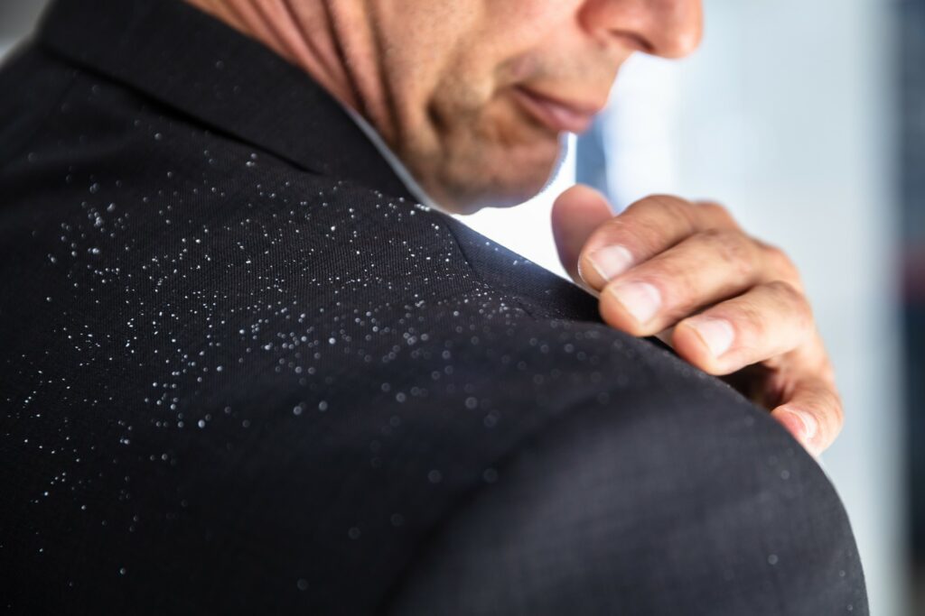 man with dandruff on shirt