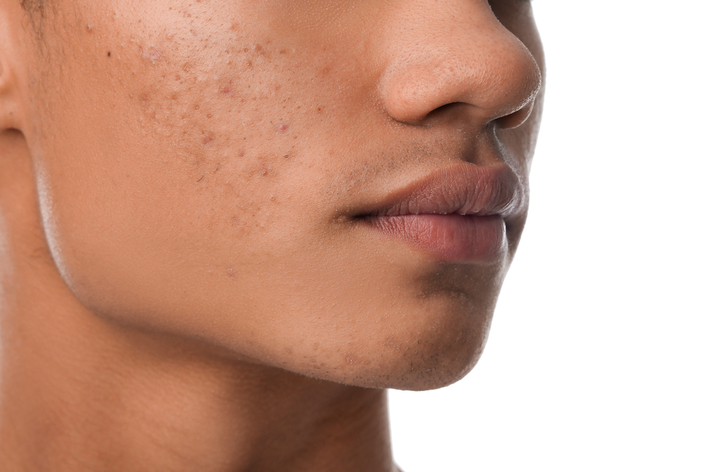 young man with acne