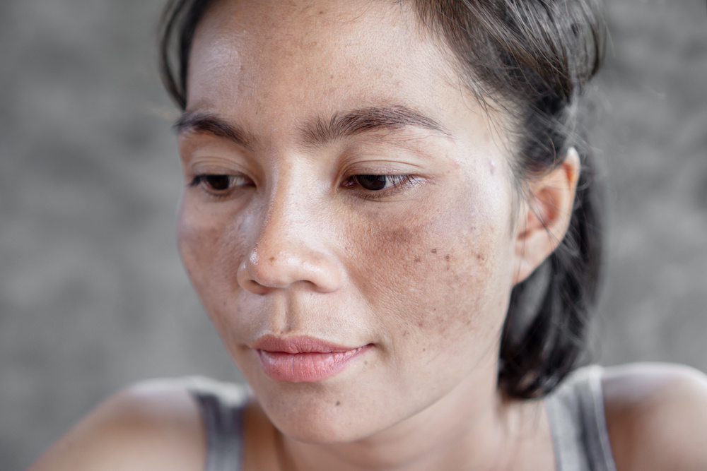 Dark Spots on Face (Melasma): Causes and Treatment