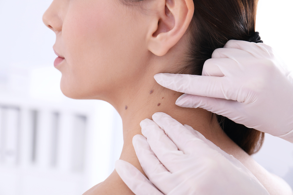 Should You Get A Mole Checked By A Dermatologist Buckhead Dermatology