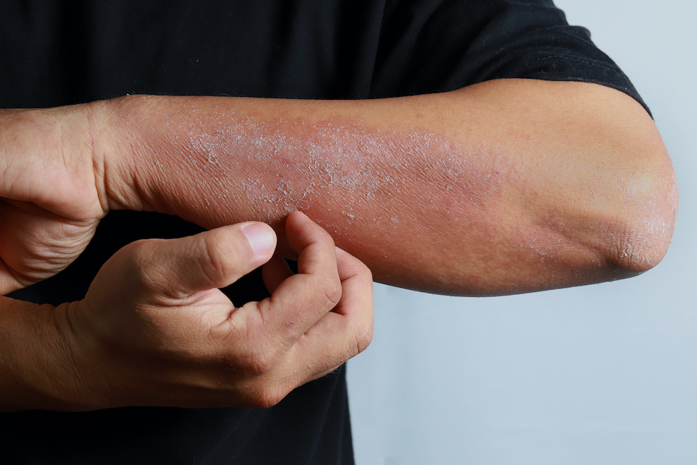 Common Causes of Rashes