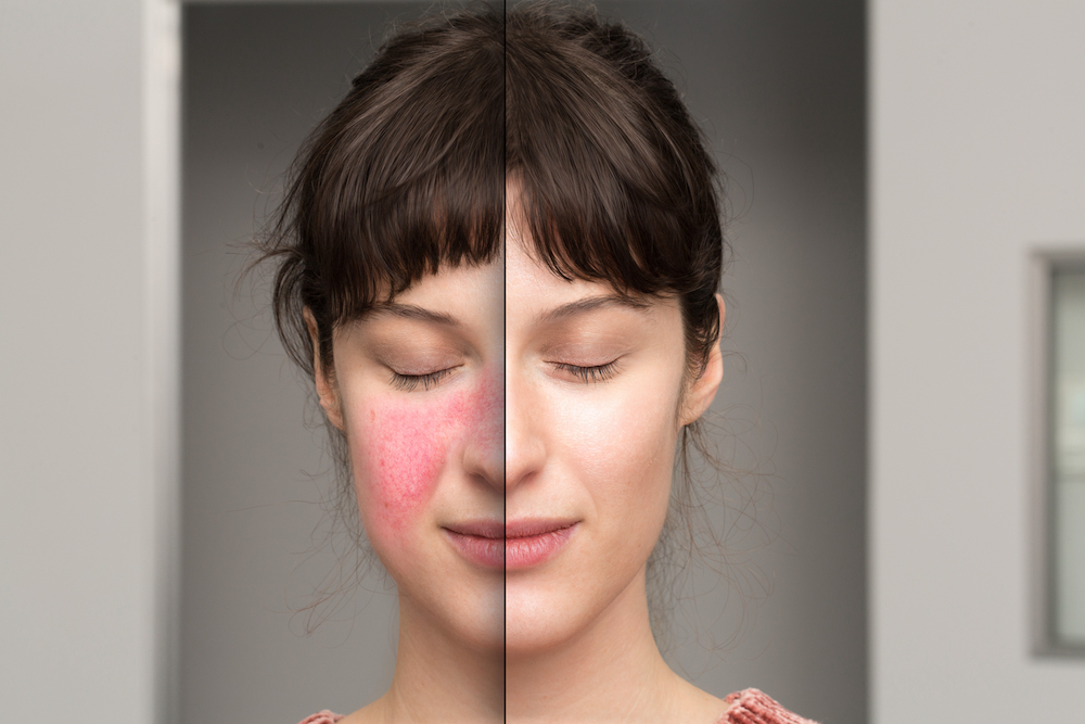 rosacea cheeks treatment