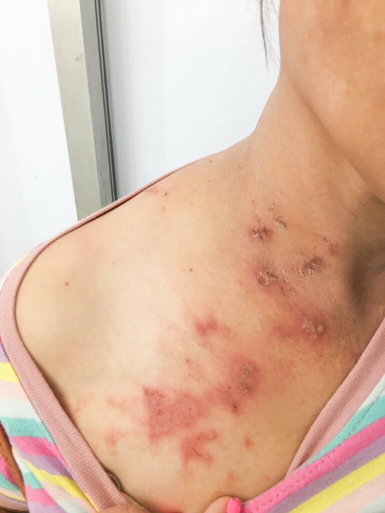 shingles treatment near me