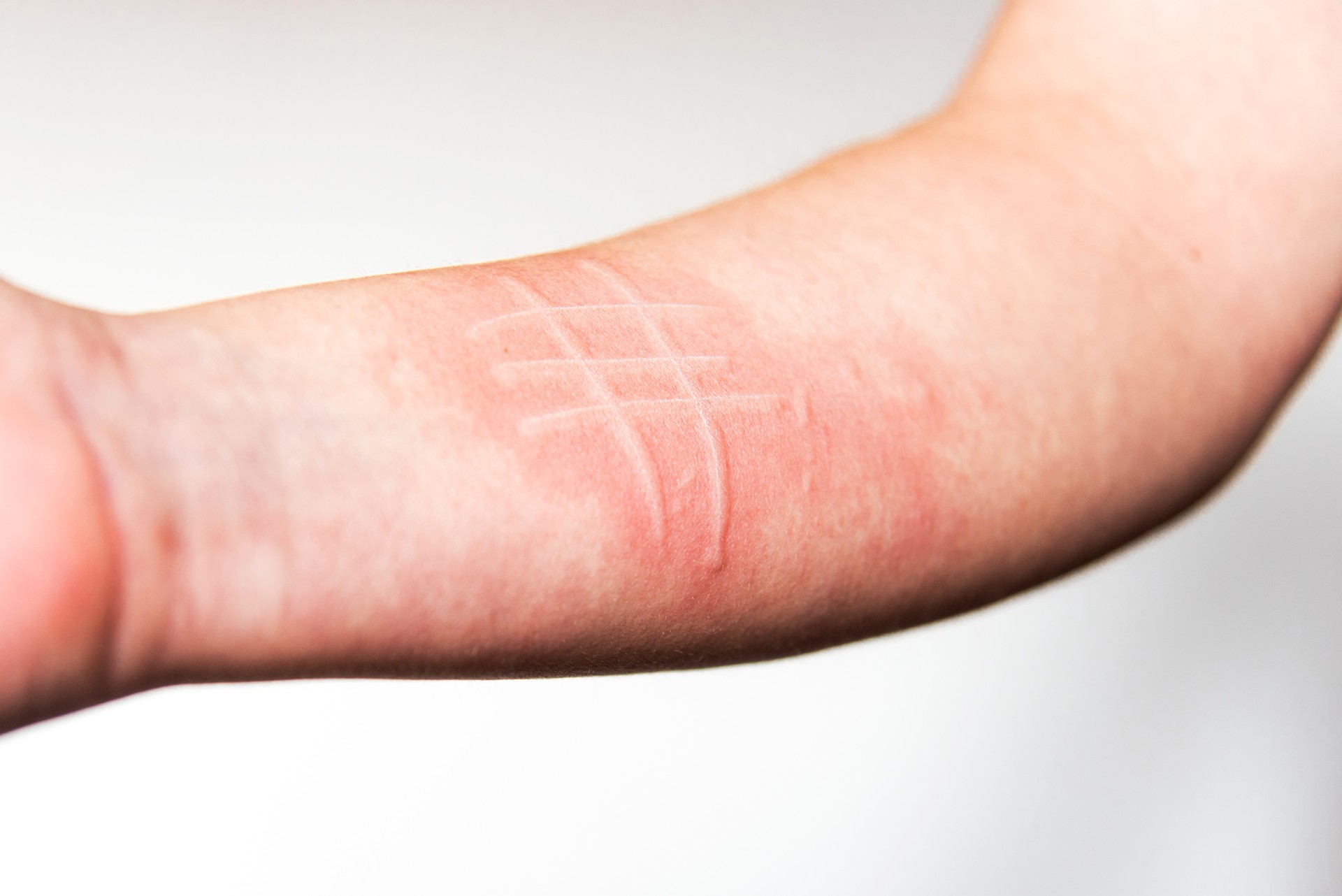 Dermatographia: Facts About a Common Skin Condition - Buckhead Dermatology