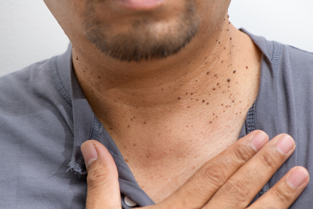 skin tags on neck