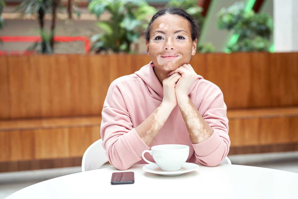 woman with vitiligo