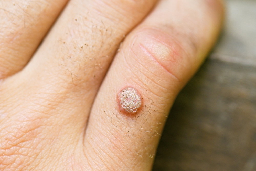 Warts 101: What You Need to Know - Buckhead Dermatology