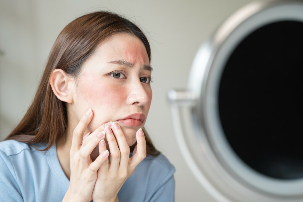 woman face in mirror cold sores acne