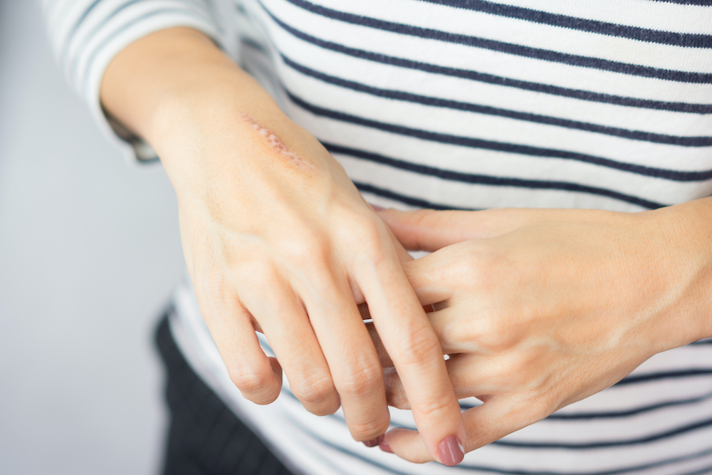 woman with burned hand